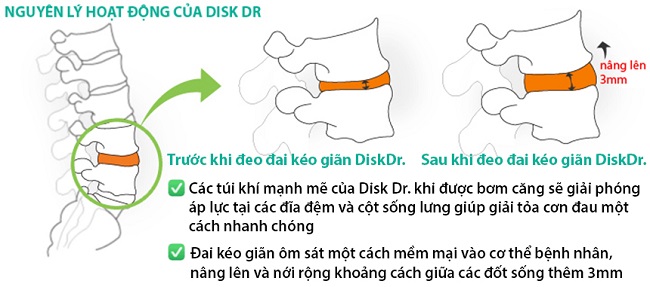 Nguyên lý hoạt động của Đai lưng bảo vệ cột sống thắt lưng Disk Dr WG-50