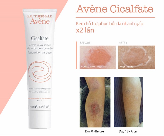  Kem trị mụn thâm Avene Cicalfate Repair Cream