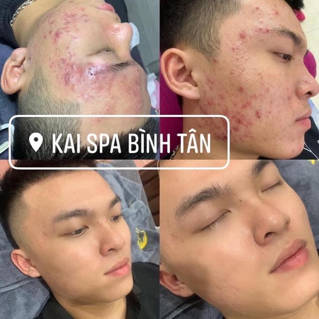 Hình ảnh khách hàng điều trị mụn tại Kai Spa | Ảnh : Kai Spa