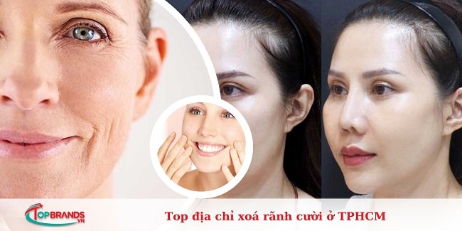 địa chỉ xoá rãnh cười ở TPHCM