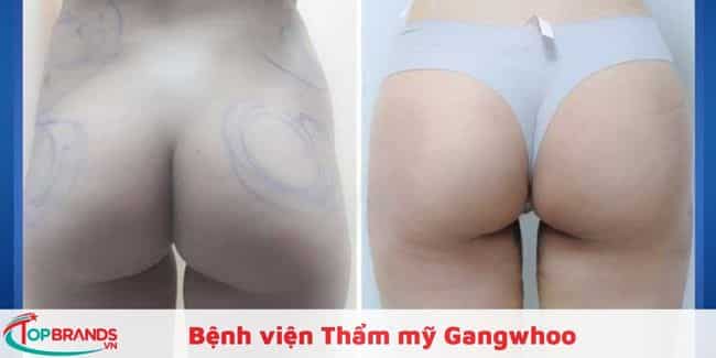 Bệnh viện Thẩm mỹ Gangwhoo