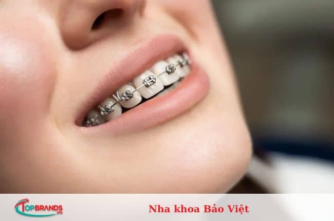 địa chỉ niềng răng trả góp tại Hà Nội