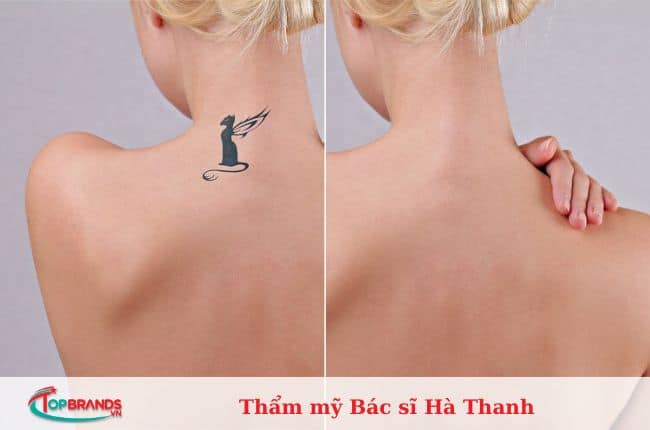 địa chỉ xoá xăm tại Hà Nội uy tín, an toàn