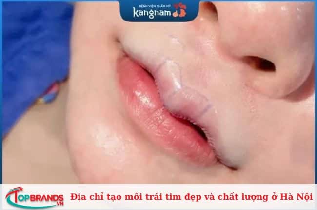 Địa chỉ tạo hình môi trái tim uy tín tại Hà Nội