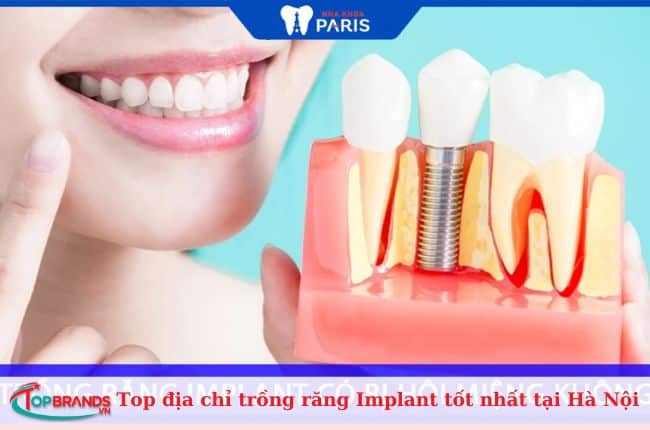 Trồng răng implant ở đâu tốt Hà Nội