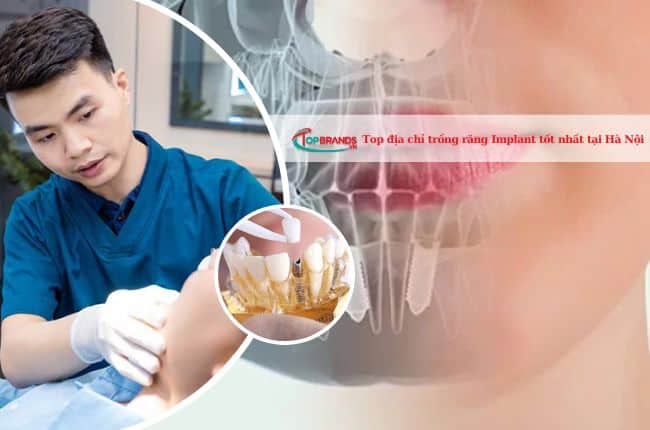 Top 13 địa chỉ trồng răng implant tại Hà Nội tốt và uy tín nhất