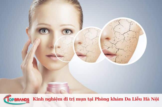 Kinh nghiệm đi trị mụn tại Phòng khám Da Liễu Hà Nội