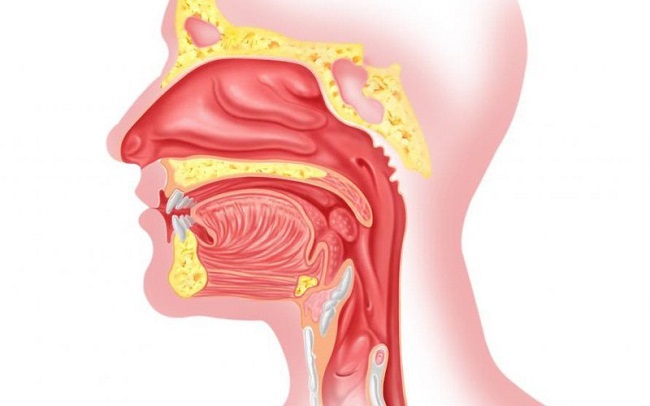 Bệnh tai mũi họng là gì? 