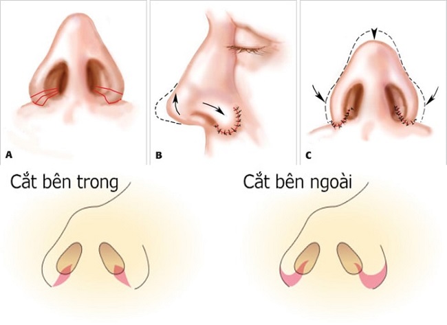Phương pháp phẫu thuật giúp khắc phục đầu mũi to cánh mũi dày