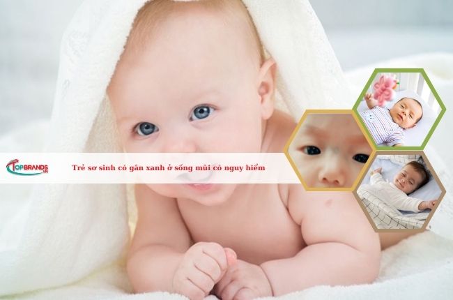 Trẻ sơ sinh có gân xanh ở sống mũi có nguy hiểm