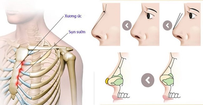 Kỹ thuật nâng mũi bằng sụn tự thân mang lại độ an toàn cao